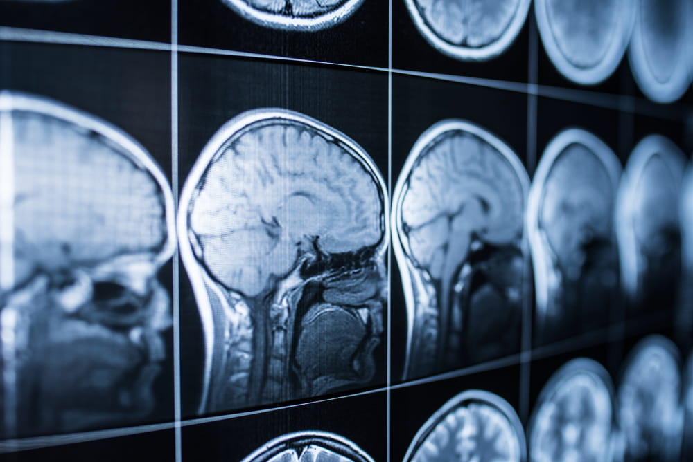 MRI scans showing brain images used to diagnose traumatic brain injuries.